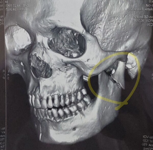 레드스트리트에서 현지 BAR 소속 직원들과의 충돌 과정에서 턱뼈 골절 등 중상을 입는 사건이 발생했다.(사진_제보자 제공)
